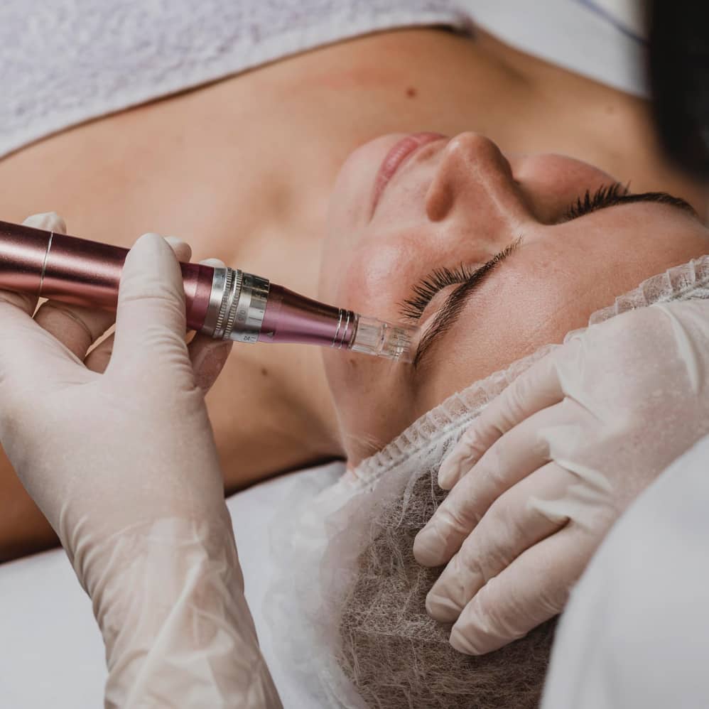 Microneedling / RF Microneedling Near Me